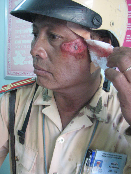 Vết thương trên mặt của Trung tá Bùi Hòa sau khi va chạm với chiếc xe container.