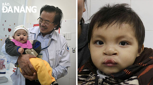 Bác sĩ Đẩu bế em bé trước phẫu thuật (ảnh trái) và sau phẫu thuật lần đầu tại Đà Nẵng. 
