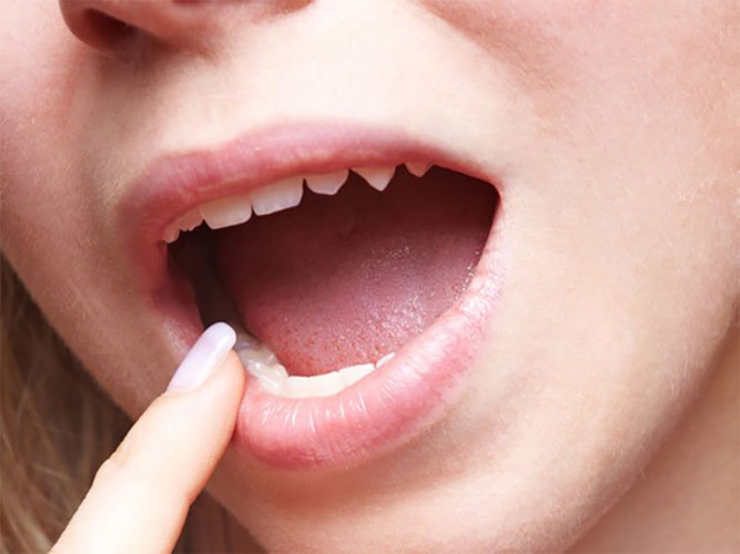 Mùi vị kim loại trong miệng: Do quá trình tích tụ chất thải trong máu, hôi miệng và sự thay đổi vị giác có thể xảy ra. Một số dấu hiệu cảnh báo sớm của suy thận bao gồm sự thèm ăn và có vị kim loại trong miệng.