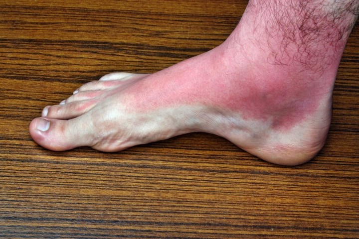 Các đốm đỏ hoặc màu sẫm trên da bạn xuất hiện mà không có lý do, đó có thể là triệu chứng của cục máu đông ở chân. Bạn cũng có thể cảm thấy nóng ở chân và thậm chí đau đớn trong khi kéo ngón chân lên.