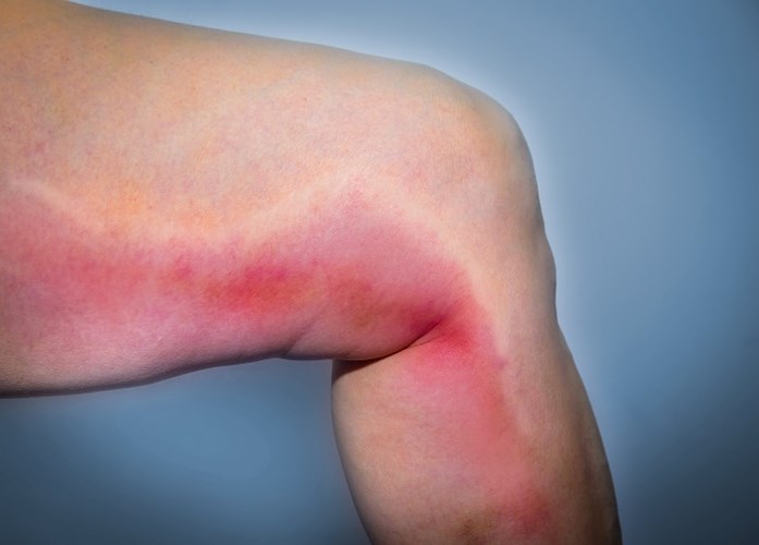 Vệt đỏ xuất hiện trên da: Bạn nhận thấy những vệt đỏ đột nhiên xuất hiện dọc theo chiều dài tĩnh mạch của chân hay cảm thấy nóng khi bạn chạm vào đó, đây có thể không phải là một vết bầm bình thường và bạn cần chăm sóc y tế ngay lập tức.