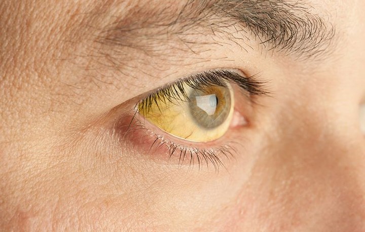 Mắt và da có màu vàng: Vàng mắt và da có thể là một dấu hiệu của suy gan và ung thư tuyến tụy. Ngay cả những khối u nhỏ cũng có thể gây áp lực và chặn ống dẫn mật có chức năng mang mật từ gan và túi mật qua tuyến tụy đến ruột non. Một trong những công việc của mật là loại bỏ bilirubin, một chất thải bình thường của hồng cầu, vì vậy khi tuyến không thể hoạt động bình thường, bilirubin dư thừa gây vàng da và mắt.
