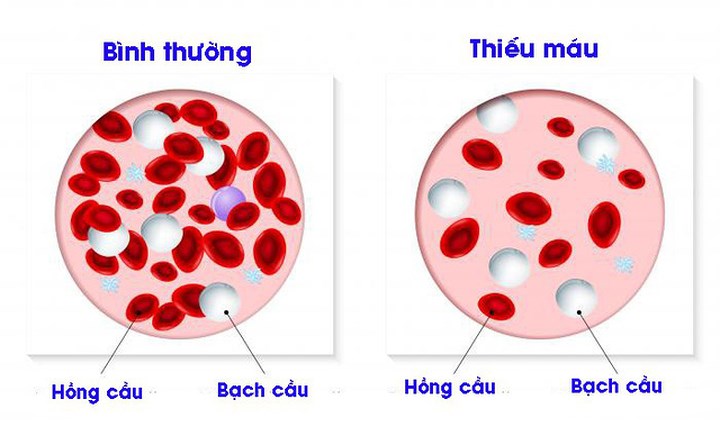 Thiếu máu: Thiếu máu là số lượng hồng cầu thấp trong cơ thể. Các hemoglobin trong các tế bào máu đỏ mang oxy khắp cơ thể. Các triệu chứng của bệnh thiếu máu như da nhợt nhạt , nhịp tim nhanh hoặc không đều, khó thở, chóng mặt, bàn tay và bàn chân lạnh,... Thiếu máu không giải thích được có thể do ung thư đại tràng. Thông thường, ung thư ở phía bên phải của đại tràng gây thiếu máu do thiếu sắt. Điều này xảy ra khi các khối u bắt đầu chảy máu từ từ vào đường tiêu hóa, gây mất máu theo thời gian.
