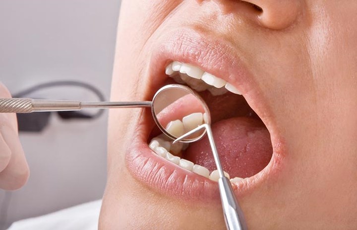 Hỏng men răng, sâu răng: Theo một nghiên cứu được công bố bởi Viện Nghiên cứu Nha khoa Mỹ, uống quá nhiều nước chanh có thể gây hại cho răng vì chanh có tính axit cao, ăn mòn men răng.