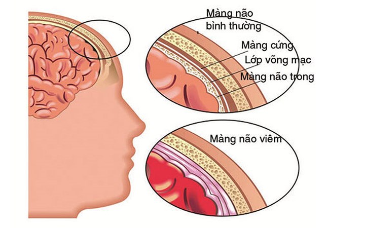 Viêm màng não: Viêm màng não là một căn bệnh có thể gây đau cổ. Bệnh do vi khuẩn hoặc virus gây viêm xung quanh các mô của tủy sống hoặc não. Các triệu chứng của căn bệnh này rất rõ ràng: sốt, nhức đầu, thậm chí nôn mửa cùng với độ cứng cổ nghiêm trọng khiến cho cổ gần như không thể di chuyển.