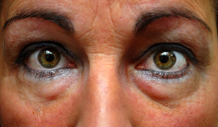 Loại bỏ các bọng mắt: Sự xuất hiện của bọng mắt có thể khiến bạn trông già hơn và mệt mỏi. Mặc dù chúng chủ yếu liên quan đến tuổi tác nhưng ngoài ra chúng cũng có thể xảy ra do thiểu ngủ và mệt mỏi.