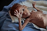 Những hình ảnh đau lòng trong cuộc khủng hoảng nhân đạo ở Yemen