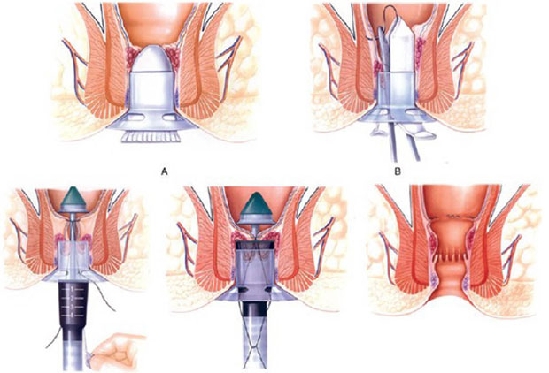 Sơ đồ phẫu thuật cắt trĩ bằng phương pháp Longo