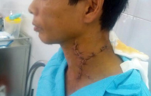 Mr Bay's neck wound after treatment