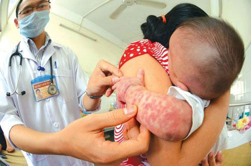 Vắc-xin thủy đậu được tiêm một liều cho trẻ từ 12 tháng đến 12 tuổi, 2 liều cách nhau 4-8 tuần với trẻ trên 13 tuổi hoặc người lớn.