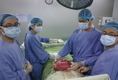 The 6.5kg tumour after removal (Photo: laodong.com.vn)