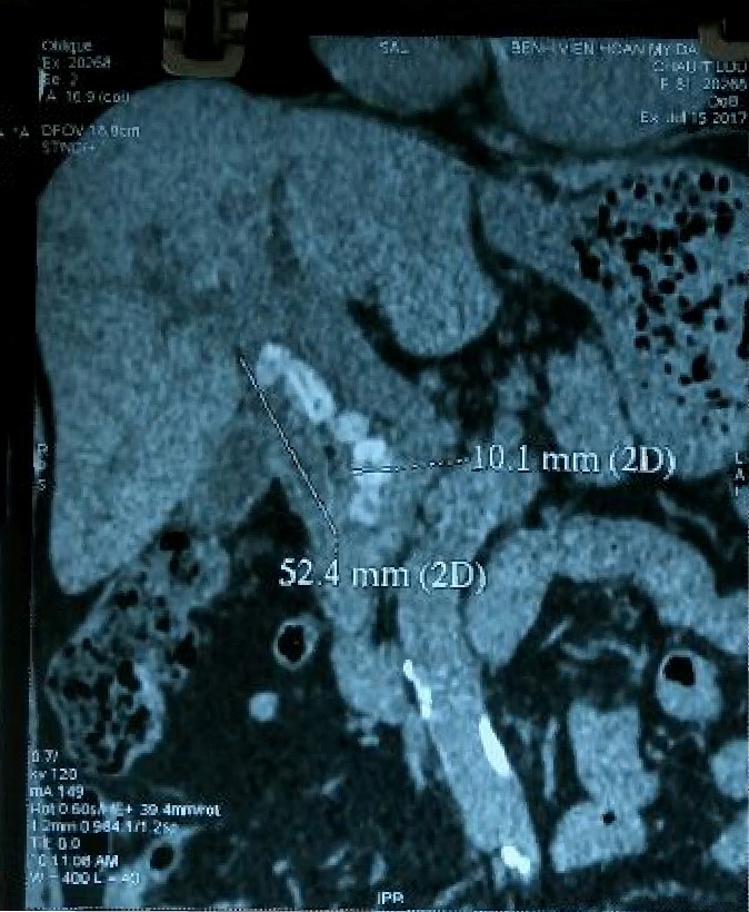 Ảnh chụp CT scan sỏi ống mật chủ bệnh nhân N.T.L (81 tuổi), Đà Nẵng có một “khối” sỏi ống mật chủ lớn, kích thước 52.4x10.1mm.