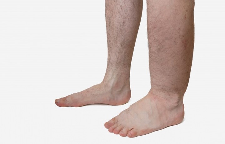 Sưng một bên chi: Một bên cẳng chân hoặc cánh tay sưng húp là một trong những dấu hiệu phổ biến của huyết khối tĩnh mạch sâu. Cục máu đông có thể làm nghẽn dòng lưu thông máu ở chân và máu đổ về phía sau cục máu đông, gây tình trạng sưng tấy.