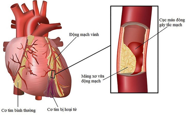 Bệnh động mạch vành (CAD) là bệnh tim phổ biến do sự tích tụ mảng bám trong thành động mạch. Quá nhiều mảng bám tích tụ trong các động mạch theo thời gian, có thể ngăn chặn lưu thông máu trong cơ thể. Trong một khoảng thời gian, CAD cũng có thể làm suy yếu cơ tim và dẫn đến suy tim. Vì CAD không gây ra bất kỳ triệu chứng nào, nó chỉ được chú ý cho đến khi bạn bị đau tim.