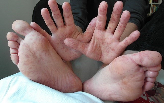 The reoccurance of virus Enterovirus 71 (EV71), a common cause of life-threatening illnesses for hand-foot-mouth (HFMD) patients, has made the disease dangerous and could easily spread into an outbreak. – VNA/VNSPhoto Read more at http://vietnamnews.vn/society/467135/experts-concern-over-over-virus.html#Ptzrp4o6qwFukKBF.99