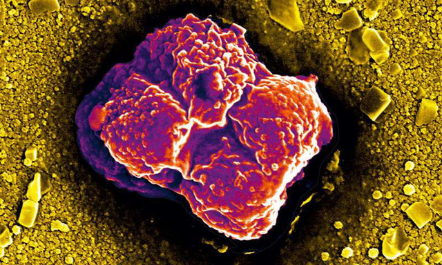 Tại sao tế bào ung thư lan ra rất nhanh khắp cơ thể?