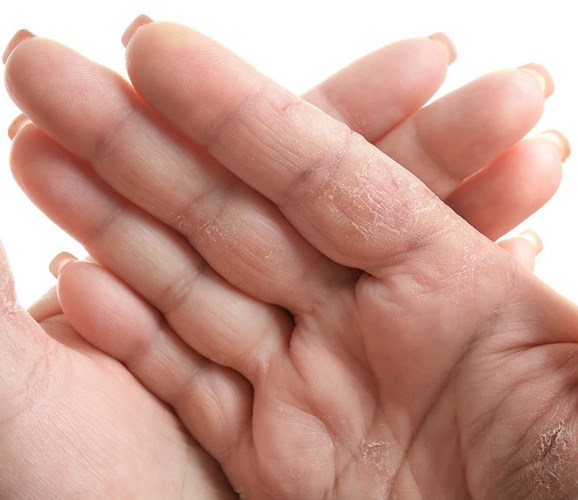 Khô da tay và cơ thể: Mùa đông, nếu những người có làn da khô thường chọn các sản phẩm chăm sóc da hữu hiệu. Làm da khô có thể là dấu hiệu của  bệnh tiểu đường và suy giáp. Nếu da của bạn không chỉ thô ráp và bong tróc mà còn chặt chẽ và đầy đủ các vết nứt, nó có thể là  viêm da gây ra bởi một phản ứng tự nhiên để tiếp xúc với hóa chất.
