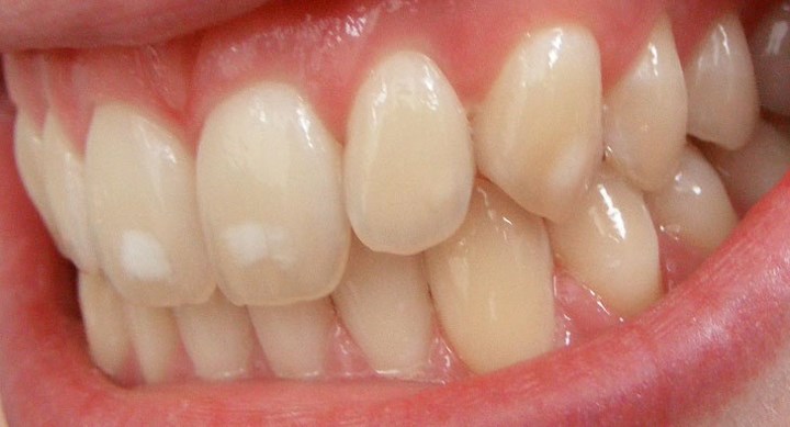 Răng: Fluorosis là một căn bệnh mãn tính phát triển hoặc trước hoặc sau khi tiêu thụ một lượng lớn nước hoặc các sản phẩm có hàm lượng cao các hợp chất flo. Có là 5 loại phân loại nhiễm fluor: đáng ngờ, rất nhẹ, nhẹ, trung bình và nặng. 3 biến thể đầu tiên biểu hiện trực quan thông qua sự xuất hiện của các vết bẩn (như trong ảnh ở trên),có thể dẫn đến việc phân hủy các mô răng và răng gãy rụng.
