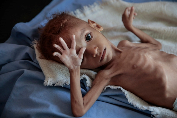 Một cậu bé bị suy dinh dưỡng nghiêm trọng nằm trong một giường bệnh ở Trung tâm Sức khỏe Aslam ở Hajjah, Yemen ngày 1/10/2018. Quốc gia này hiện trải qua cuộc khủng hoảng nhân đạo tồi tệ do xung đột liên miên kéo dài trong suốt 3 năm qua. Hàng triệu người Yemen đang trên bờ vực của nạn đói. 