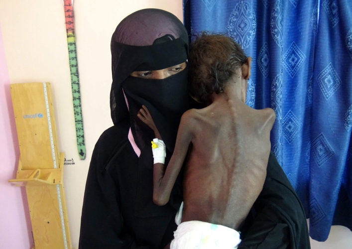 Người mẹ Yemen Nadia Nahari bế cậu con trai 5 tuổi Abdelrahman Manhash tại một bệnh viện ở quận Khokha nằm ở phía tây tỉnh Hodeidah ngày 22/11/2018. 