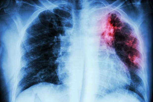 Xác định loại gene mở ra hy vọng cho bệnh nhân ung thư phổi