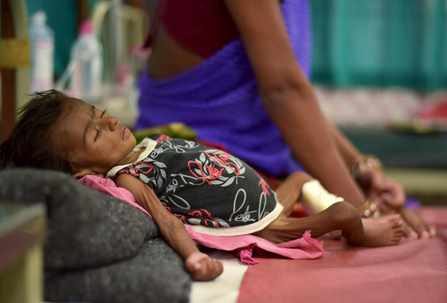 Một em bé suy dinh dưỡng tại Ấn Độ. Ảnh: Reuters