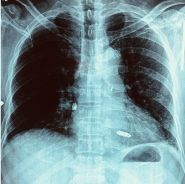 Máy tạo nhịp tim không dây nằm trong buồng thất phải của bệnh nhân dưới hình ảnh chụp Xquang.