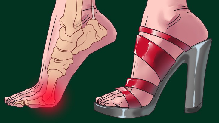 Ngoài bàn chân, 3 bộ phận cơ thể này cũng tổn thương vì giày cao gót