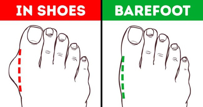 Giảm biến dạng ngón chân: Để tránh biến dạng ngón chân, bạn nên đi chân đất nhiều hơn nhằm tăng cường cơ bắp chân và cho phép bàn chân cùng ngón chân được ở vị trí tự nhiên, không bị gò ép bởi giày dép.