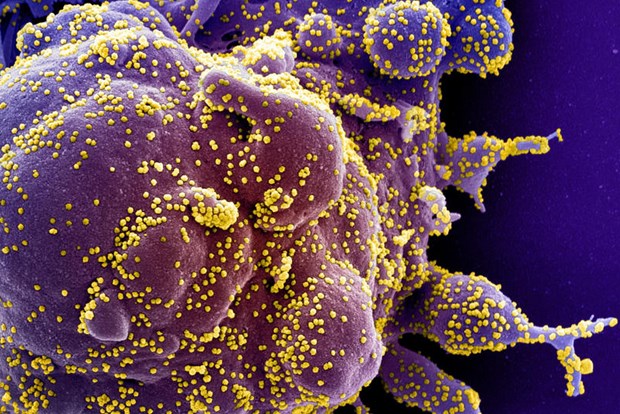 Colorized scanning electron micrograph of a dying cell (purple) infected with SARS-COV-2 virus particles (yellow), isolated from a patient sample. Image captured at the NIAID Integrated Research Facility in Fort Detrick, Maryland. (Photo: NIH via Reuters)