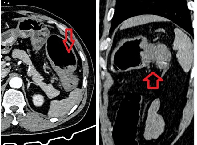 Hình ảnh u đại tràng góc lách của bệnh nhân gây bán tắc ruột.