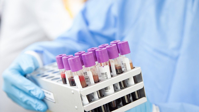 Phương pháp xét nghiệm máu phát hiện sớm 5 bệnh ung thư
