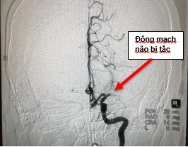 Hình ảnh chụp mạch máu của chị Hoa bị tắc trước (trái) và sau (phải) khi được các bác sĩ Vinmec Đà Nẵng can thiệp.