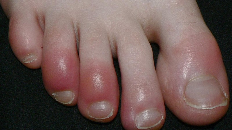 Một bệnh nhân mắc chứng cước ngón chân. Ảnh: Wikipedia