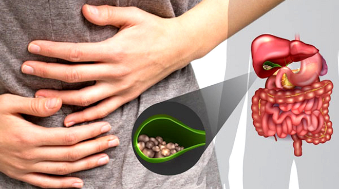 Đau bụng là triệu chứng sỏi mật hay bị nhầm thành bệnh dạ dày.