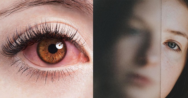 Mắt mờ và đỏ là triệu chứng điển hình của viêm mắt.