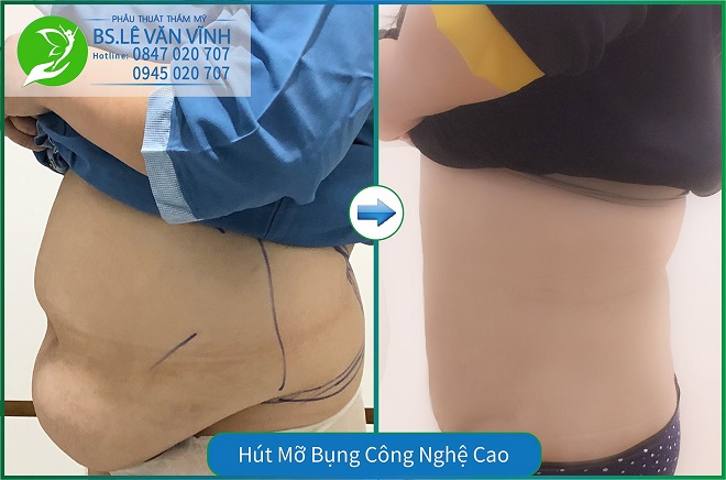 Hút mỡ bụng mang đến hiệu quả cao khi thực hiện ở bác sĩ giỏi.