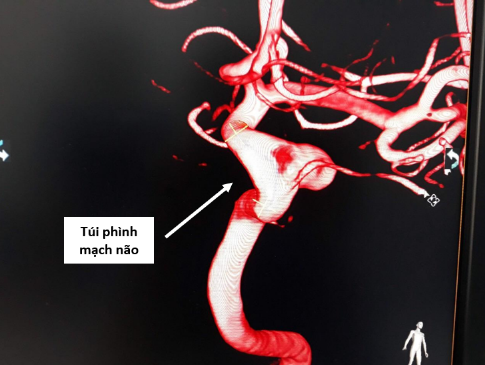 Một ca bệnh túi phình mạch não được các bác sĩ chỉ định đặt phương pháp can thiệp nội mạch loại bỏ túi phình bằng kỹ thuật stent chuyển dòng