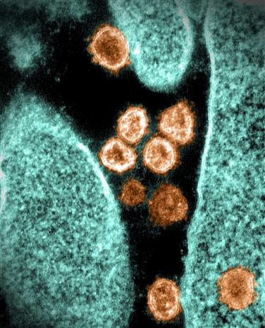  Hình ảnh từ kính hiển vi virus SARS-CoV-2 trong mẫu bệnh phẩm của bệnh nhân Covid-19 ở Mỹ. Ảnh: AFP/TTXVN