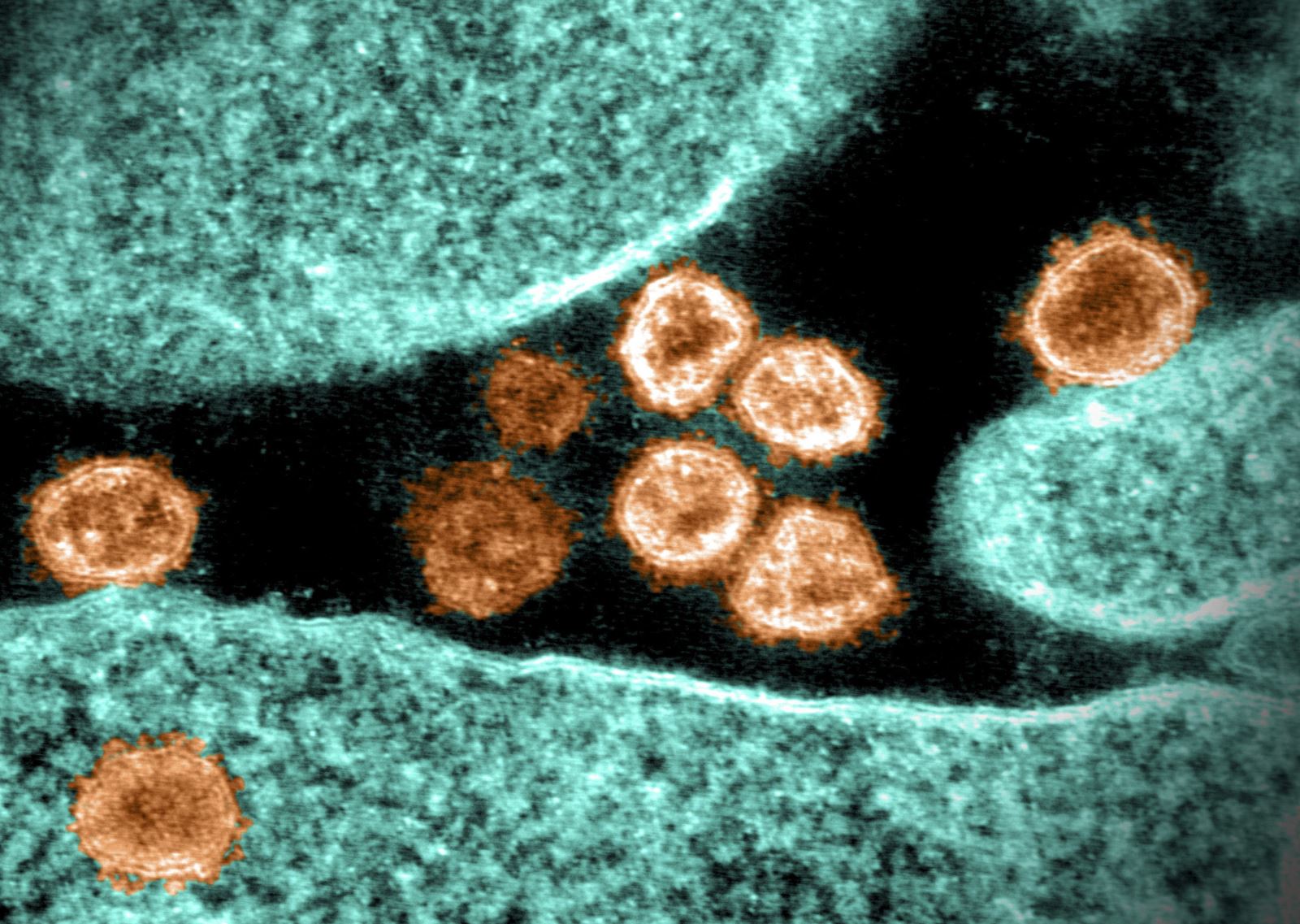 Hình ảnh từ kính hiển vi do Viện nghiên cứu bệnh truyền nhiễm và dị ứng quốc gia Mỹ cung cấp cho thấy virus SARS-CoV-2 trong mẫu bệnh phẩm của bệnh nhân mắc COVID-19 ở Mỹ. Ảnh tư liệu: AFP/TTXVN