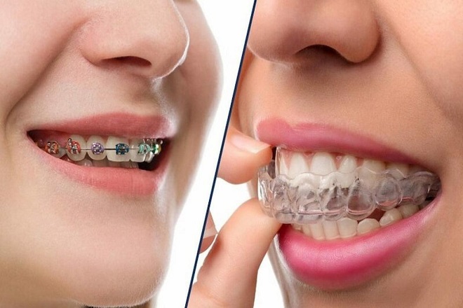 Niềng răng trong suốt thẩm mỹ và an toàn hơn niềng răng mắc cài.