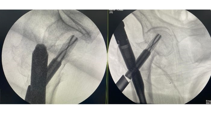 Phẫu thuật bệnh nhân 90 tuổi bị té gãy xương đùi bằng kỹ thuật tiên tiến