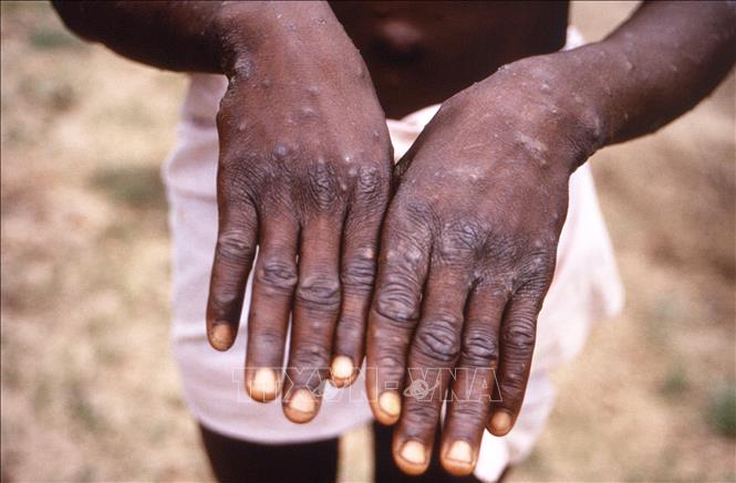 Bệnh nhân mắc đậu mùa khỉ ở Congo. Ảnh:AFP/TTXVN