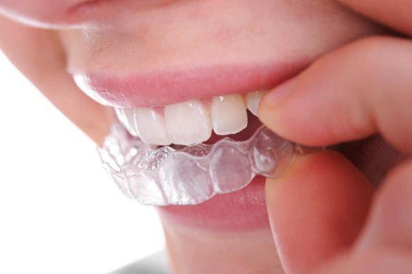 Giải đáp lo lắng niềng răng trong suốt có đau không?