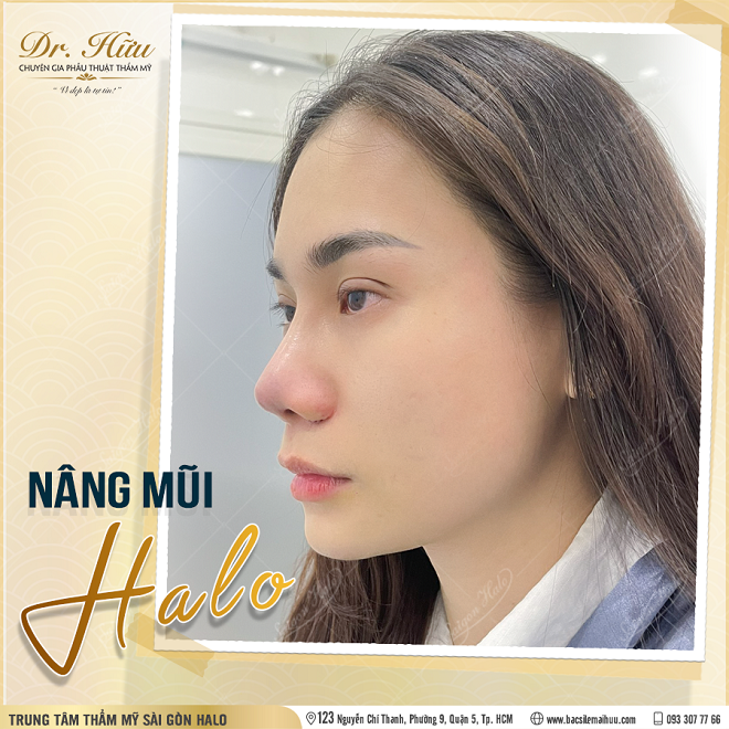 Nâng mũi công nghệ mới được áp dụng tại Sài Gòn Halo.