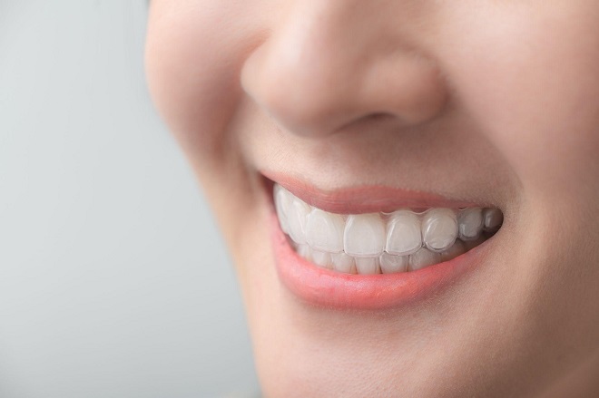 Niềng răng trong suốt Invisalign ngày càng được ưa chuộng vì tính thẩm mỹ cao, vệ sinh và ăn nhai dễ dàng, thoải mái.