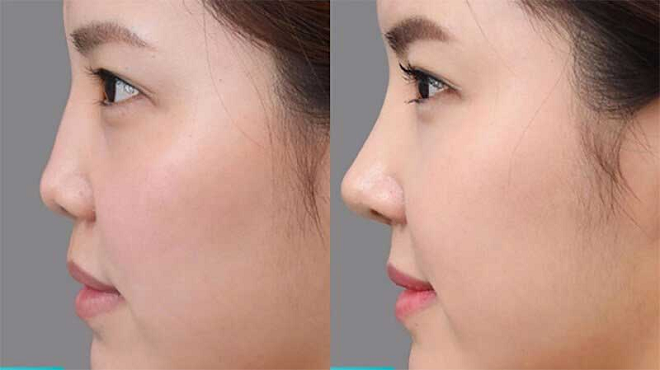Phương pháp khắc phục mũi tẹt hiệu quả nhất