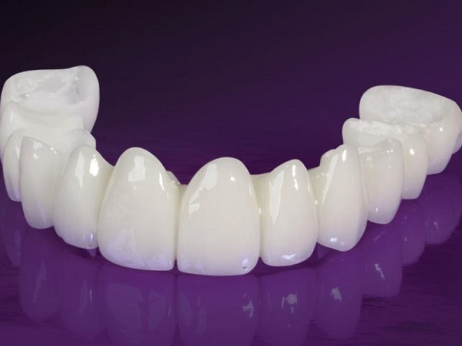 Răng sứ Diamond lành tính, có độ bền cao và màu trắng sáng tự nhiên.