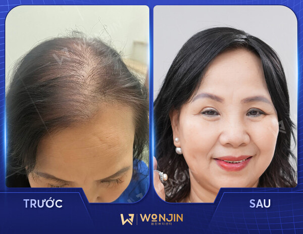 Khách hàng tự tin với trải nghiệm tăng sinh nang tóc tại Wonjin.
