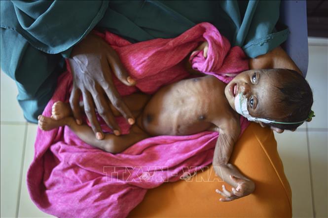 Trẻ em bị suy dinh dưỡng do thiếu lương thực điều trị tại một bệnh viện ở Baidoa, Somalia. Ảnh minh họa: TTXVN